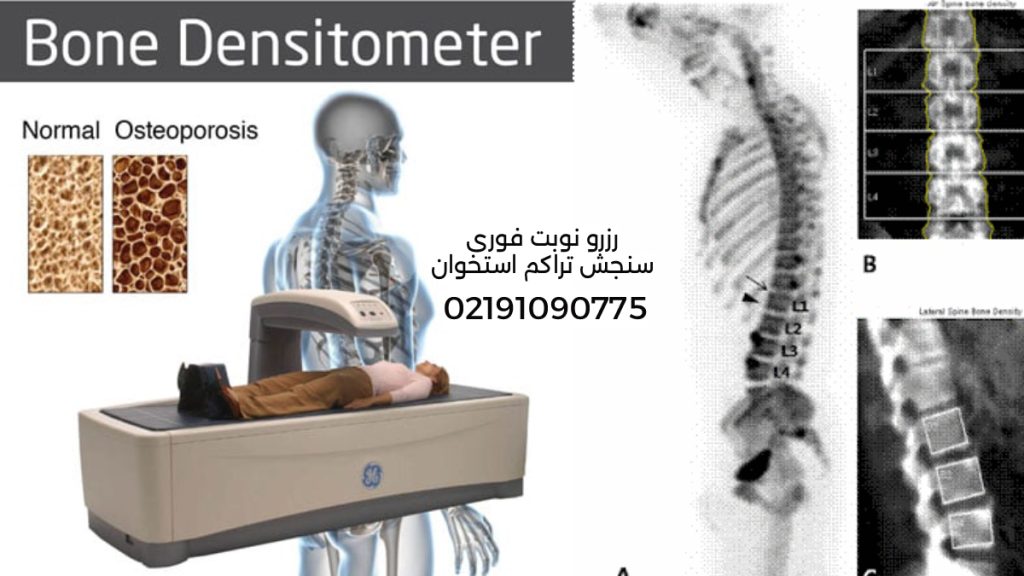 پوکی استخوان و استخوان سالم تصاویری از سنجش تراکم استخوان استخوان سالم و پوک شماره مرکز سنجش تراکم استخوان و تصویر ستون فقرات
