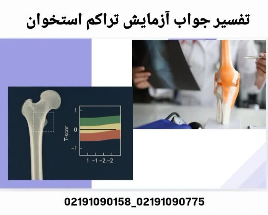 تفسیر جواب آزمایش تراکم استخوان - راهنمای خواندن T-Score و Z-Score در گزارش DEXA