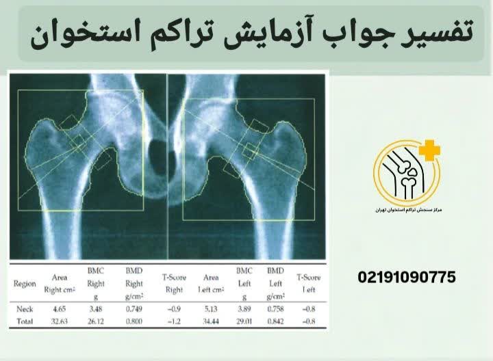  نمونه جواب سنجش تست تراکم استخوان