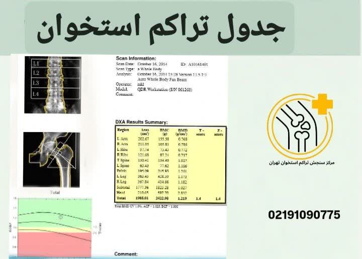جدول تراکم استخوان
