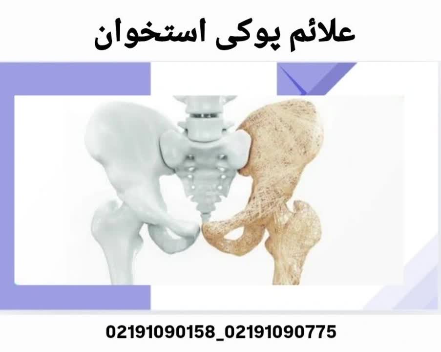 علائم پوکی استخوان در زنان - کاهش قد، خمیدگی پشت و شکستگی با ضربه خفیف
