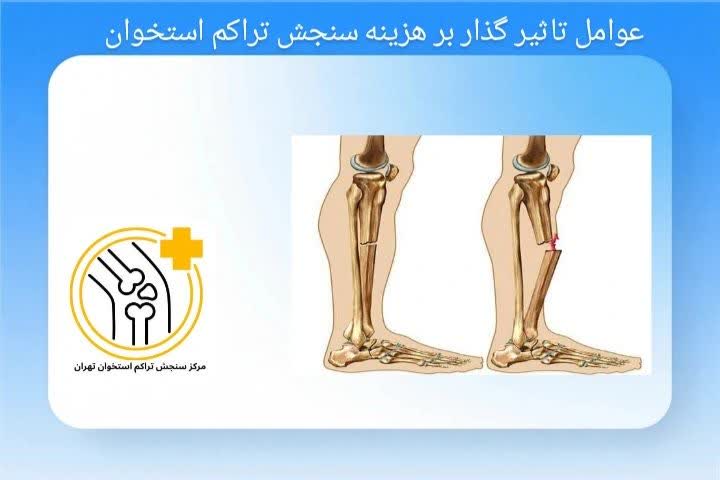 عوامل تاثیرگذار بر هزینه سنجش تراکم استخوان