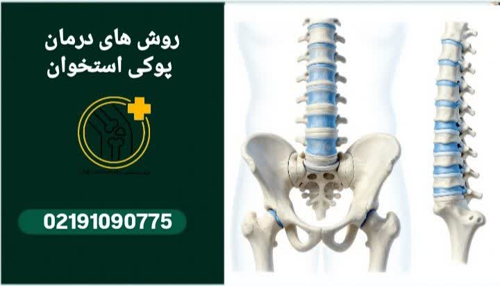 روش درمان پوکی استخوان