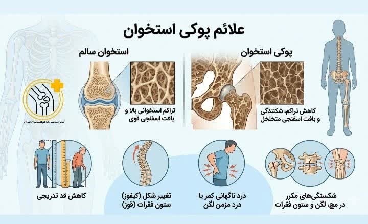 علائم پوکی استخوان
