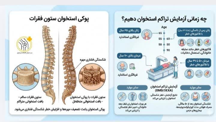 علائم پوکی استخوان در ستون فقرات