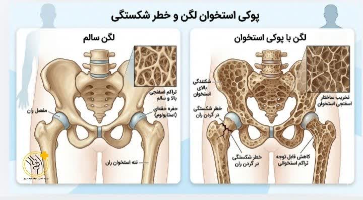 علائم پوکی استخوان لگن