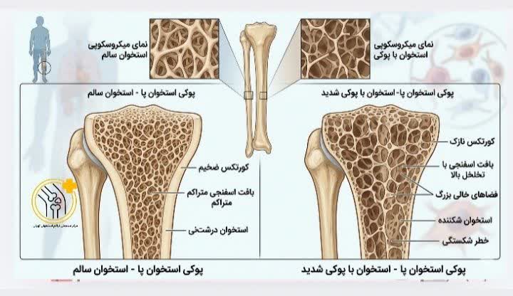 علائم پوکی استخوان پا