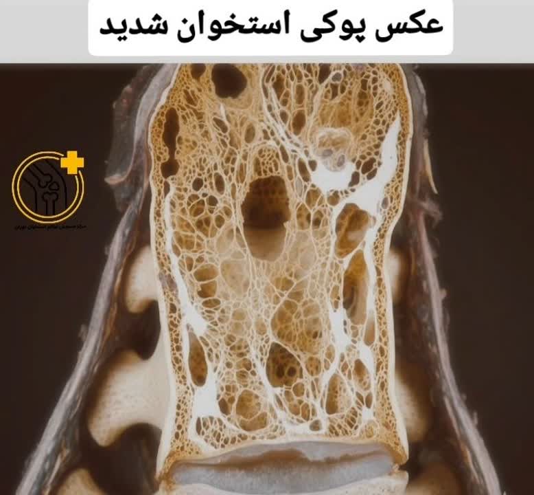 عوارض پوکی استخوان شدید