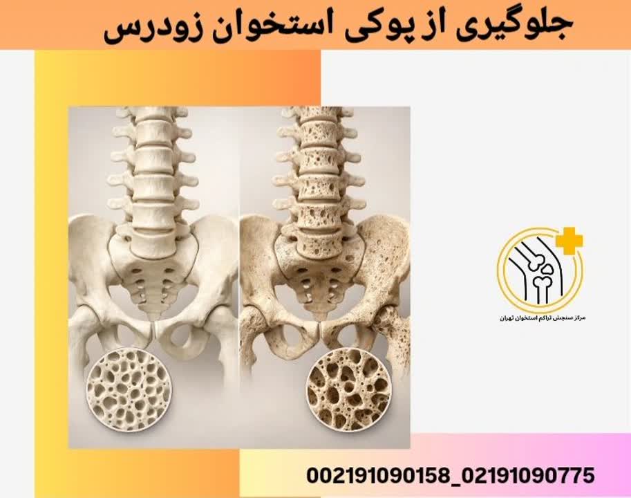 جلوگیری از پوکی استخوان زودرس