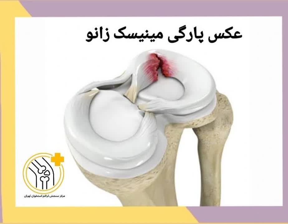 تصویر آسیب مینیسک، عکس پارگی غضروف زانو، تصویر آسیب دیدگی مینیسک. عکس پارگی مینیسک زانو