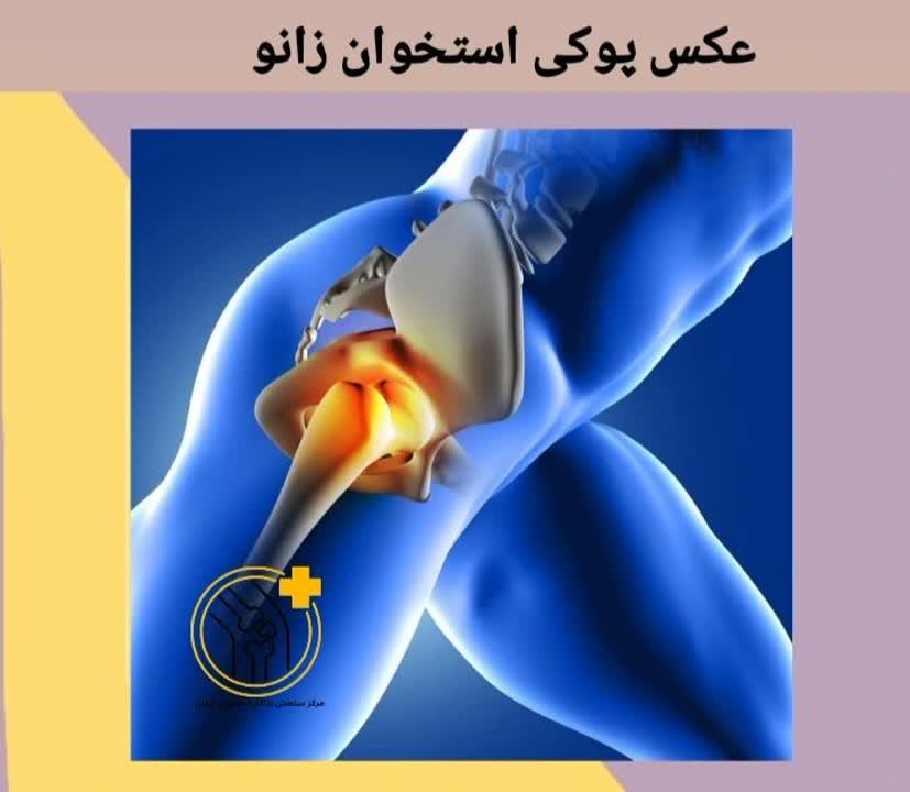 تصویر شماتیک یا رادیولوژی زانو با تمرکز بر کاهش تراکم استخوانهای اطراف مفصل. عکس پوکی استخوان زانو