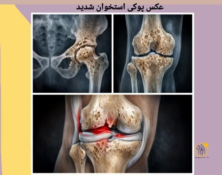 صویر شماتیک مقایسهای استخوان سالم و استخوان با کاهش تراکم شدید (پوکی شدید). عکس پوکی استخوان شدید