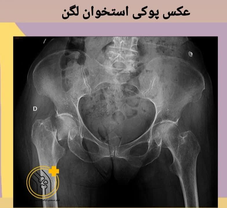 رادیوگرافی (عکس) لگن نشاندهنده نازک شدن قشر استخوان و تغییرات استئوپروز. عکس پوکی استخوان لگن