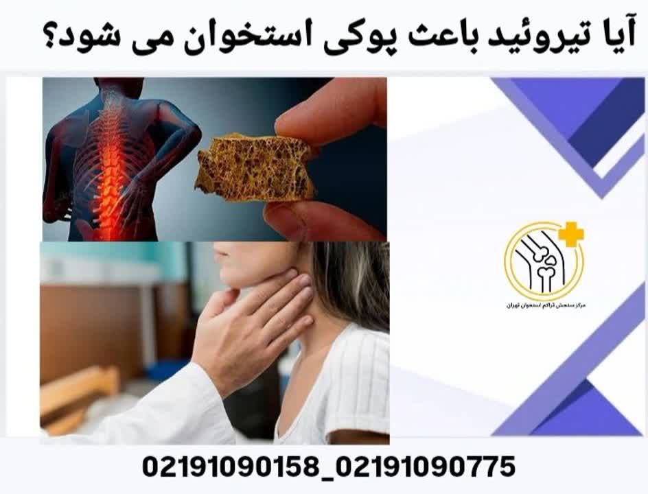 بیماری تیروئید و پوکی استخوان