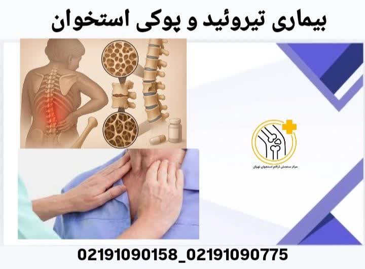 بیماری تیروئید و پوکی استخوان
