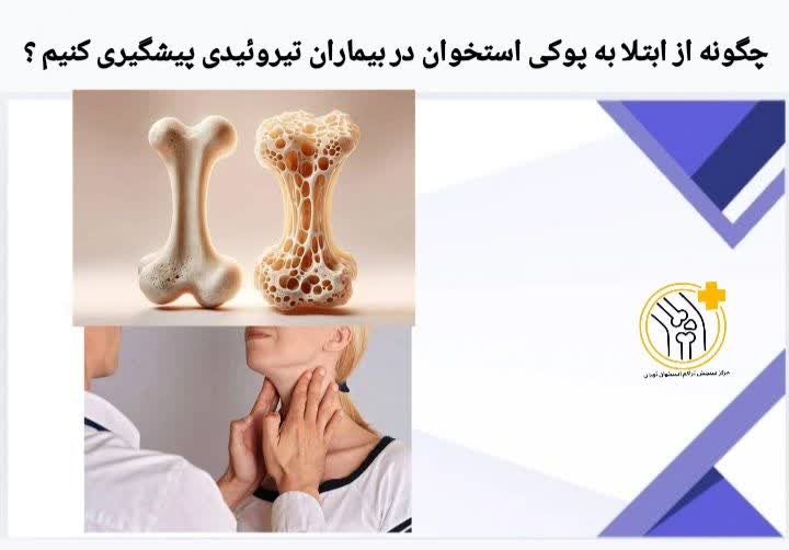 کنترل دقیق هورمون تیروئید، تغذیه مناسب و سبک زندگی فعال بهترین راههای پیشگیری از پوکی استخوان در بیماران تیروئیدی هستند. چگونه از ابتلا به پوکی استخوان در بیماران تیروئیدی پیشگیری کنیم ؟