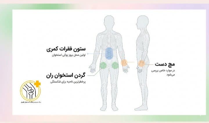  آزمایش تراکم استخوان برای کدام استخوان‌ها انجام میشود؟
