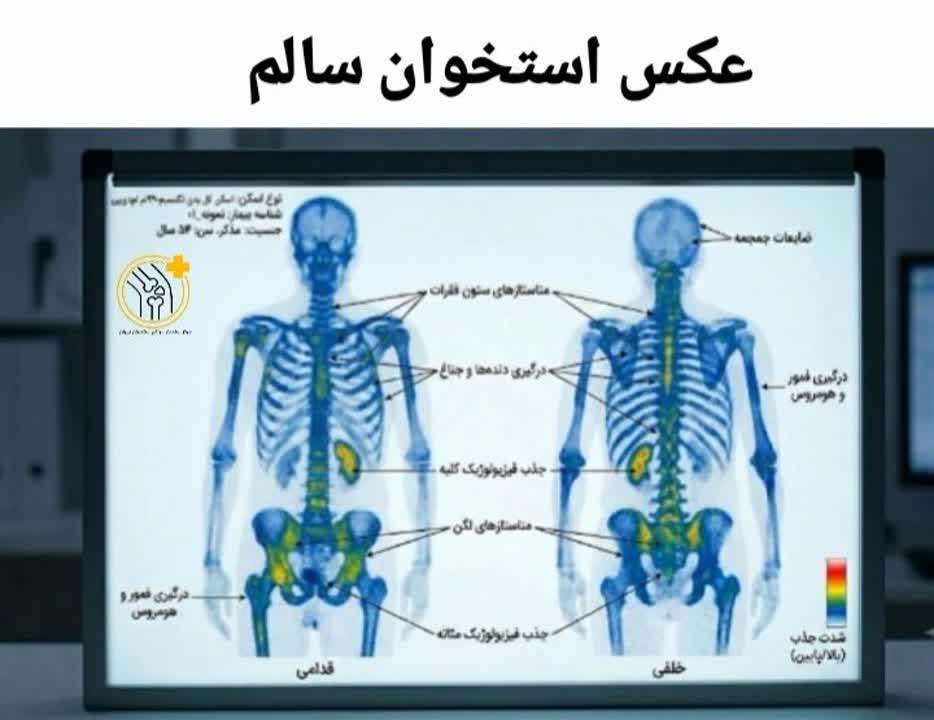 عکس اسکن استخوان سالم عکس اسکن استخوان سالم با توزیع یکنواخت