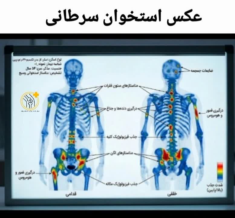 عکس اسکن استخوان سرطانی عکس اسکن استخوان سرطانی| هات اسپات در ناحیه مشکوک