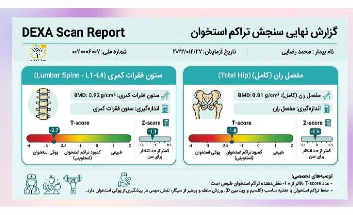 نمونه نتیجه آزمایش تراکم استخوان؛ پس از مشخص‌شدن سن مناسب آزمایش تراکم استخوان،