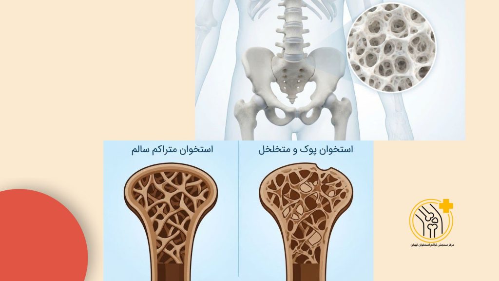 عکس استخوان متراکم سالم و استخوان پوک و متخلخل