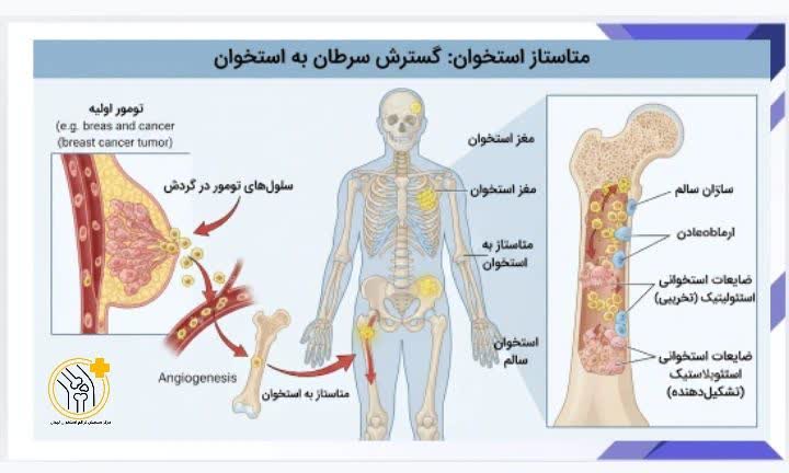 علائم متاستاز استخوان شامل درد شدید و شکستگی.