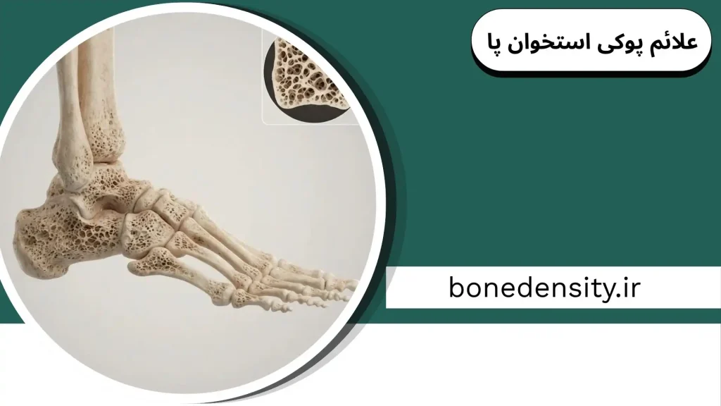 علائم پوکی استخوان پا شامل درد کف پا و ورم مچ